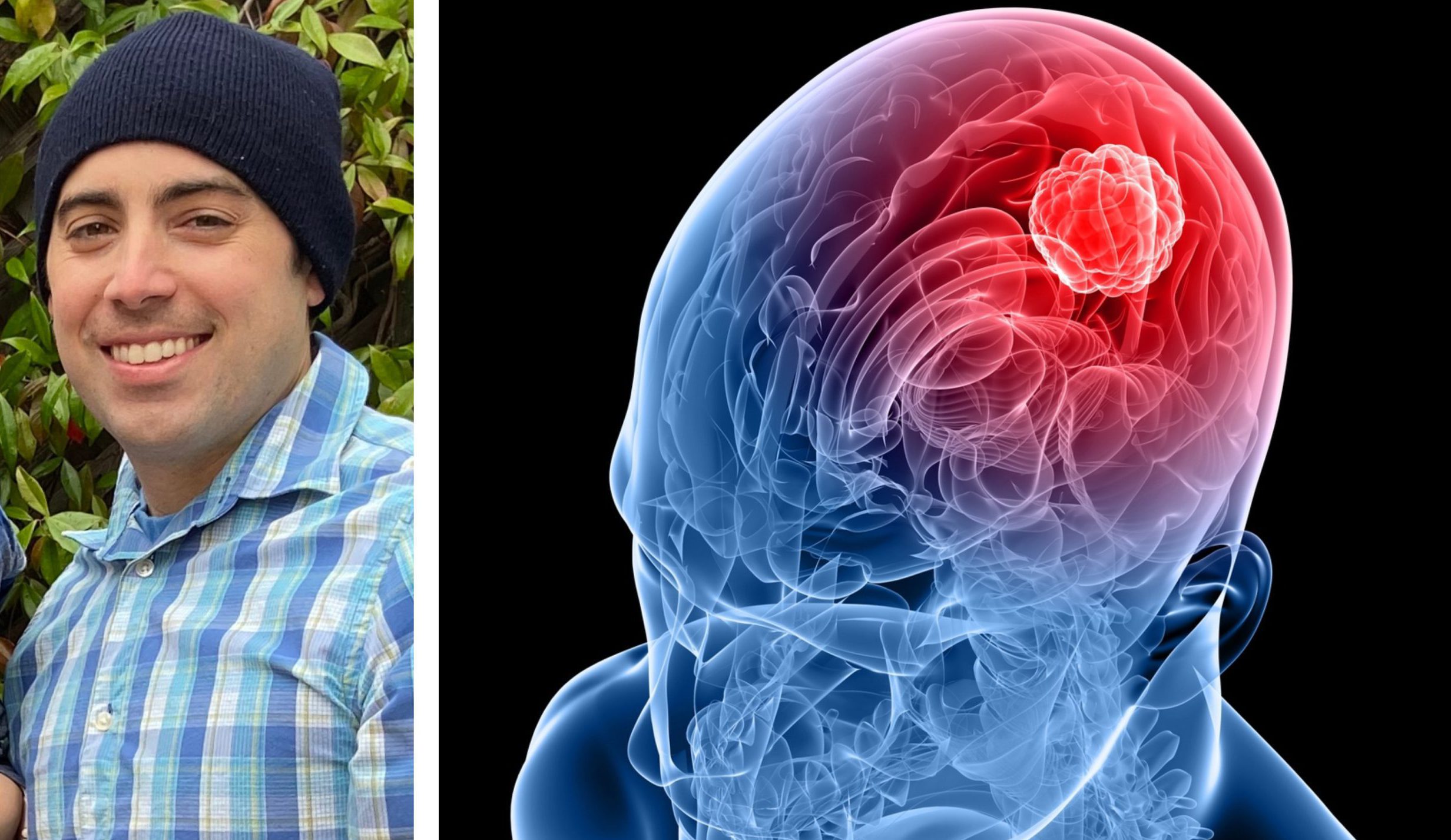 Man Survives Brain Cancer, Now His Tumor May Help Others | Vitals