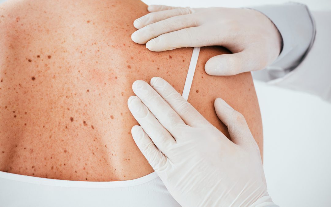 Drug Trial Gives Woman With Stage 4 Melanoma Shot at Remission