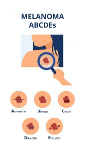 poster on how to spot melanoma ABCDE