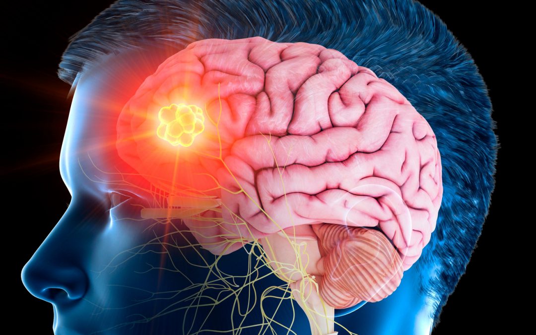 Brain Surgeons Getting a Clearer Picture to Remove Tumors