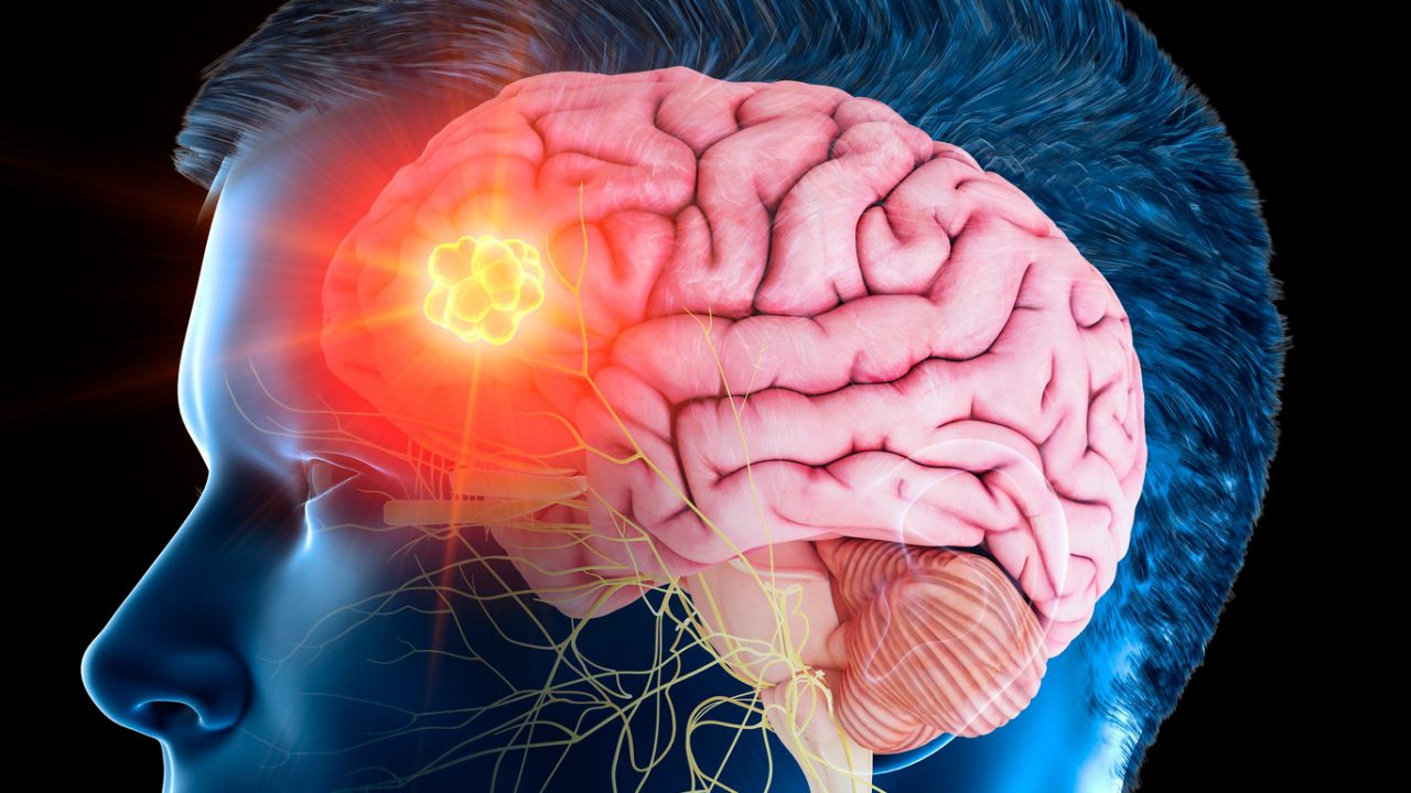 Brain Surgeons Getting a Clearer Picture to Remove Tumors Vitals