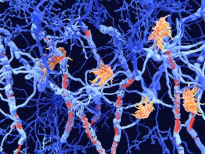 Multiple sclerosis damages nerve cells (neurons) in the brain and spinal cord. Cells called microglia attack other cells that form the insulating myelin sheath around a neuron’s axons, which destroys the myelin sheath.