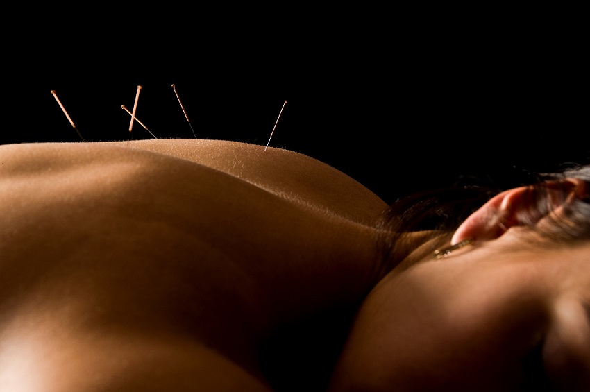 Acupuncture needles in person's back and shoulders
