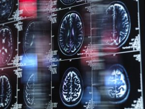 Image of MRI brain scans