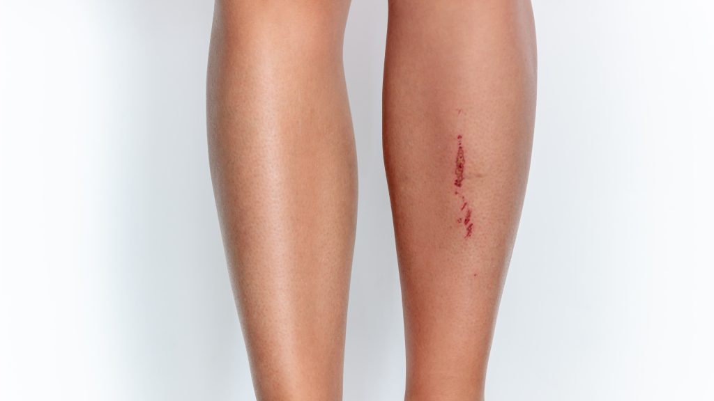 Woman's legs with wound on right