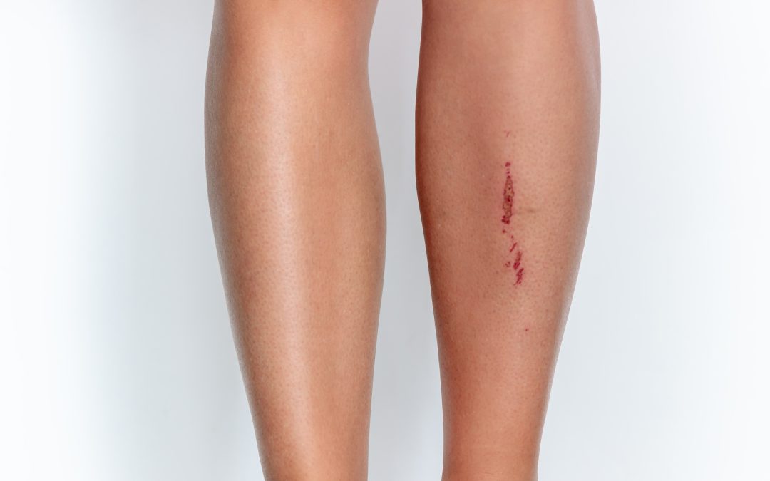 How a Simple Cut Led to Urgent Medical Diagnosis