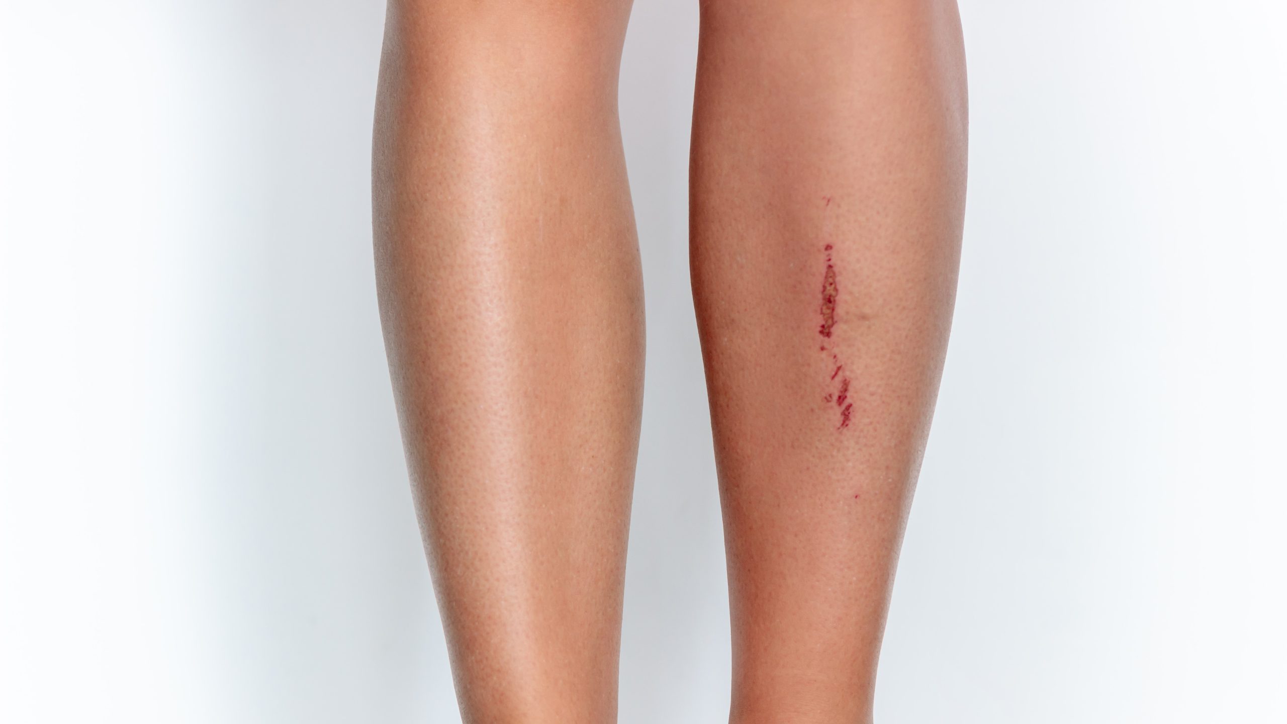 Woman's legs with wound on right