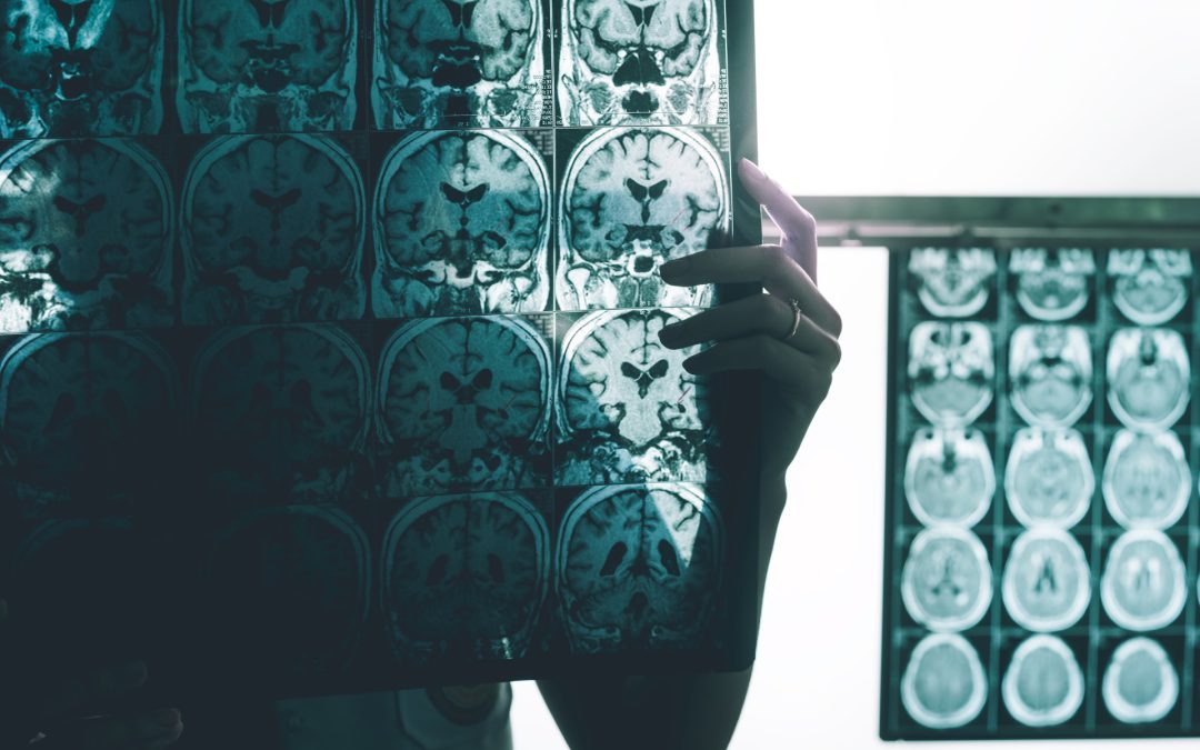 Hidden in DNA: New Study Traces Alzheimer’s Roots