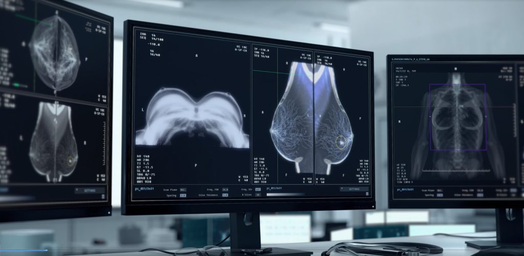 Images of breasts from mammogram on computer screen