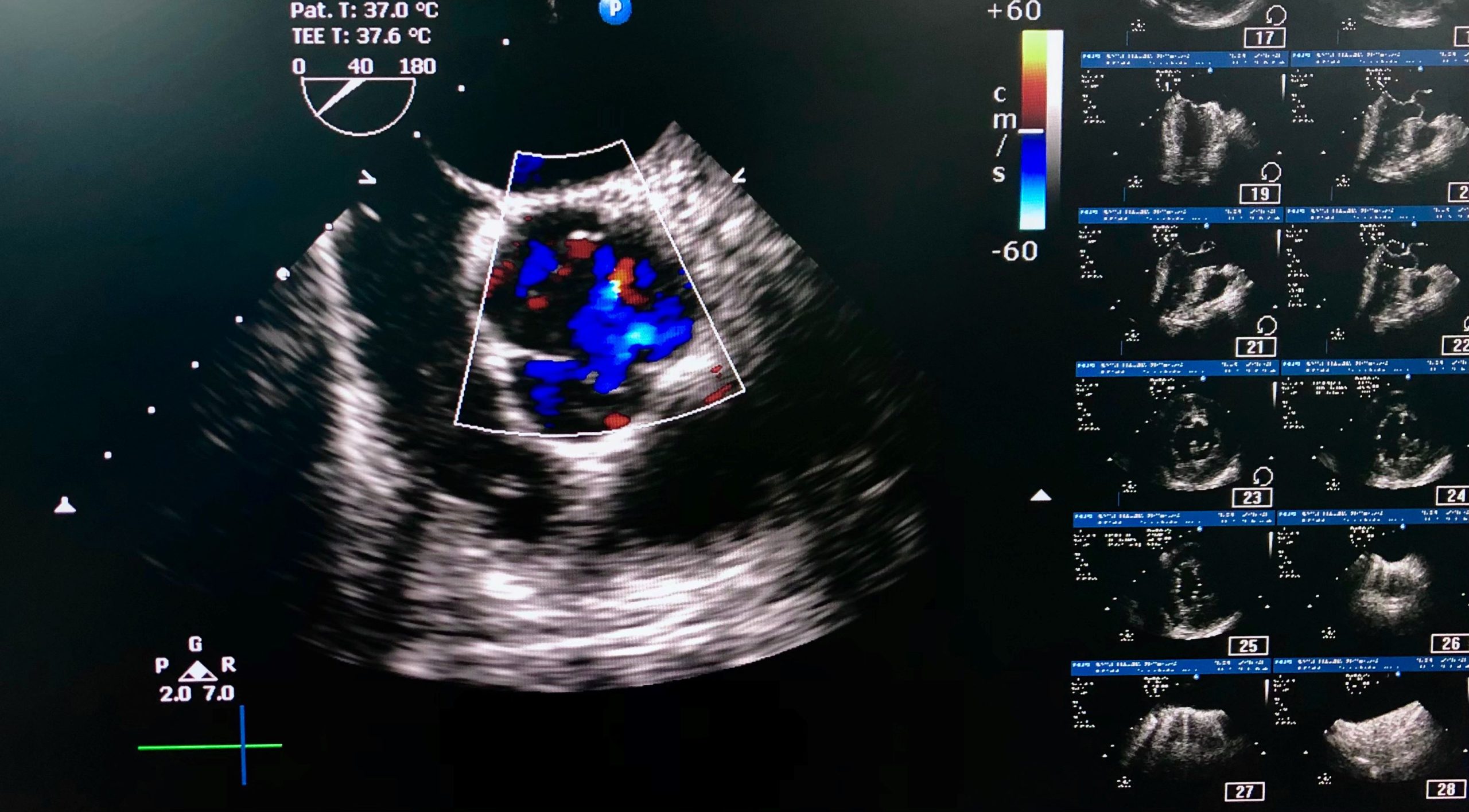 Transesophageal echocardiogram (TEE) shown normal Aortic valve (AV) opening in parasternal short axis view under color doppler