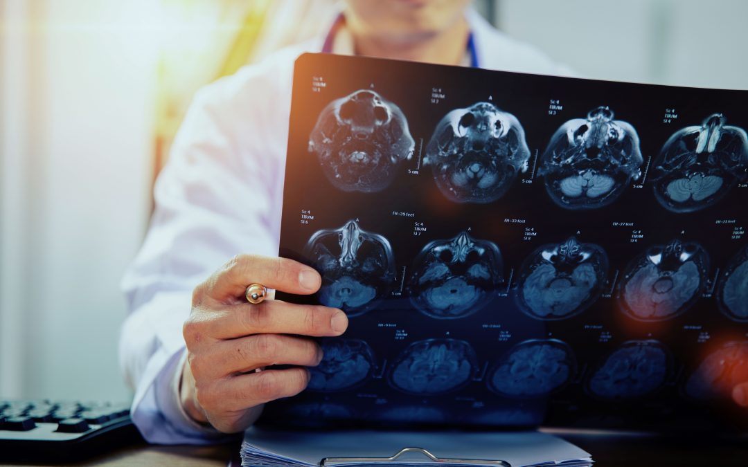 Sutter Neurologist Receives Global Recognition