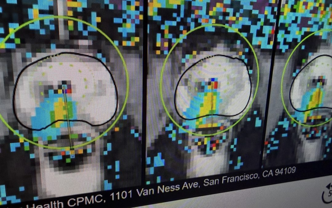 S.F. Architect Is First at Sutter to Receive MRI-Guided Prostate Treatment